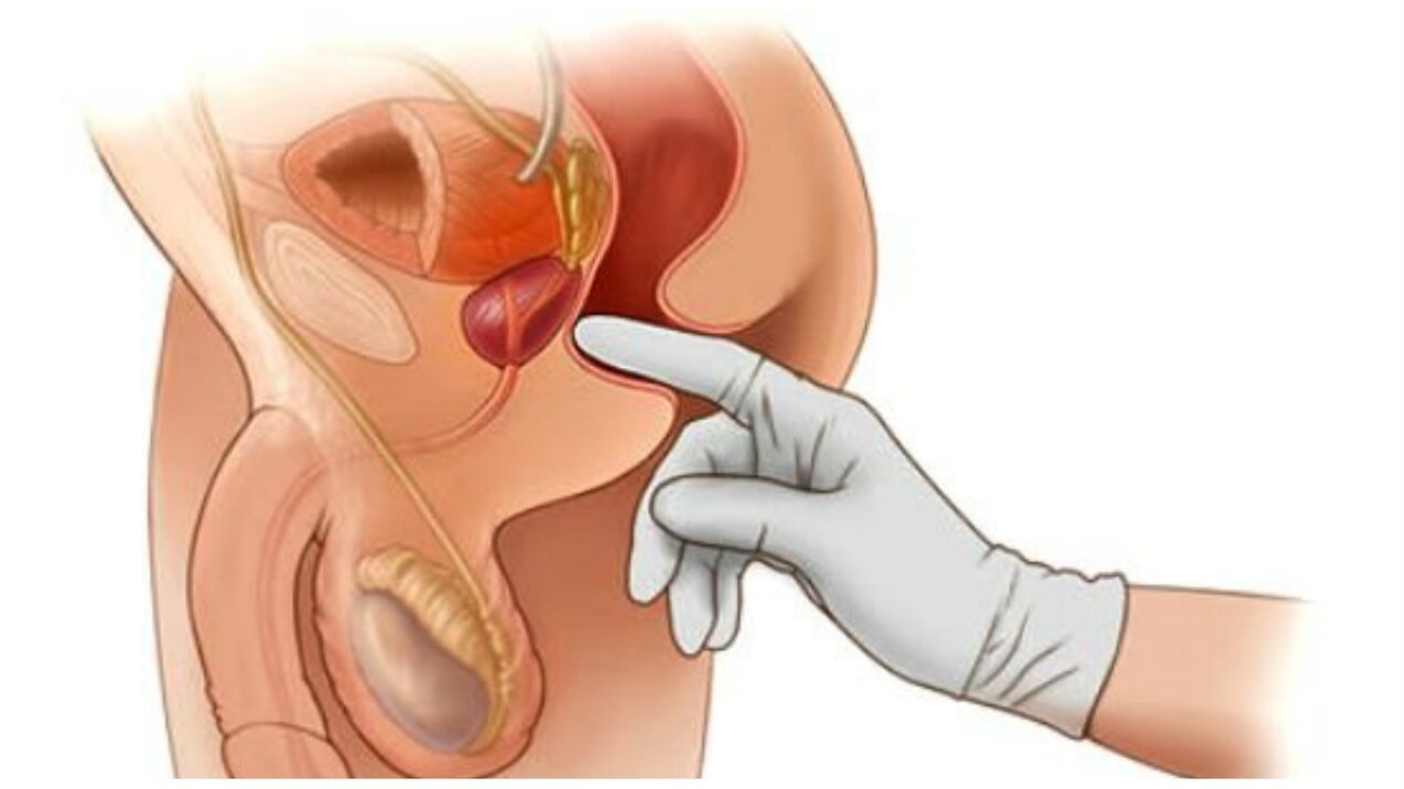 prostate massage para sa talamak na prostatitis