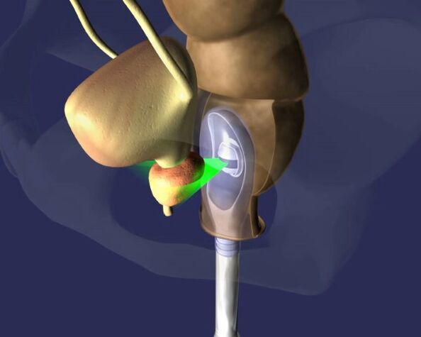 ang epekto ng ultrasound sa prostate na may prostatitis