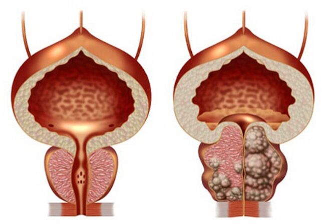 malusog na prostate at prostate adenoma