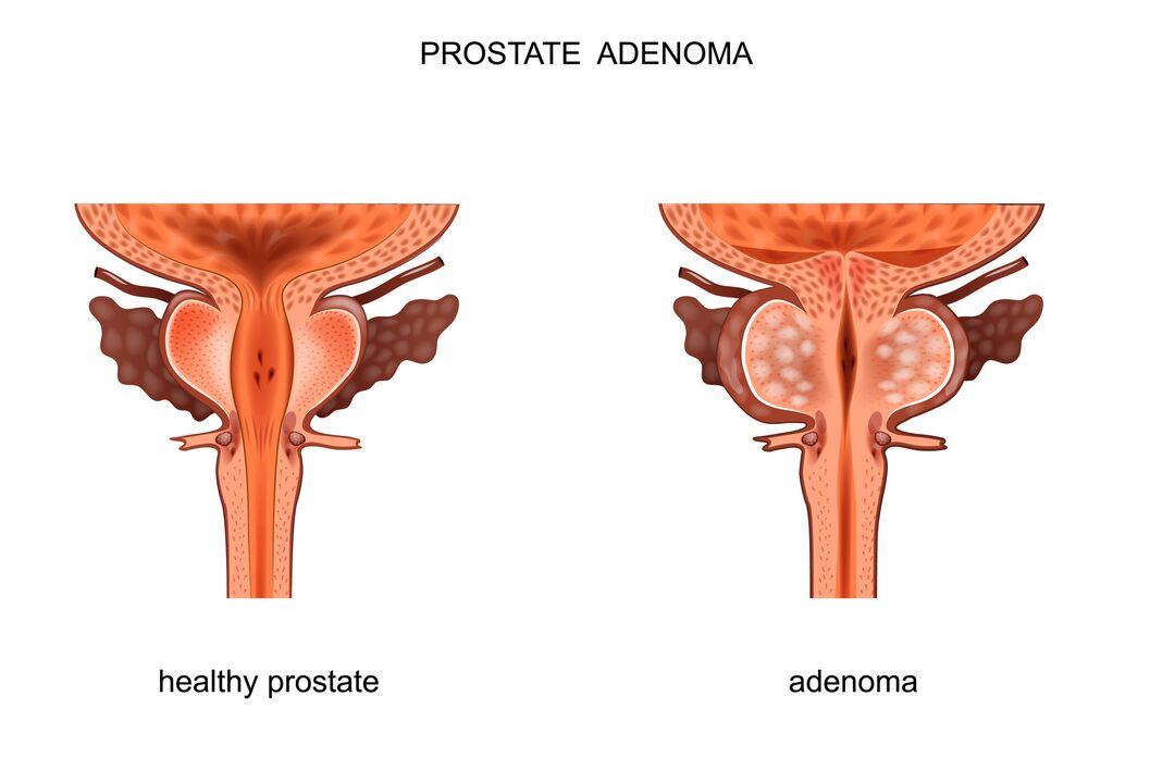 malusog na prosteyt at may adenoma